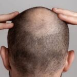 Alopecia: factores que la causan y los distintos tipos