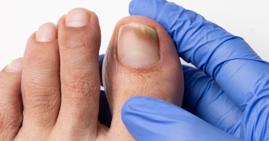 Cuáles son los tipos de hongos que afectan los pies