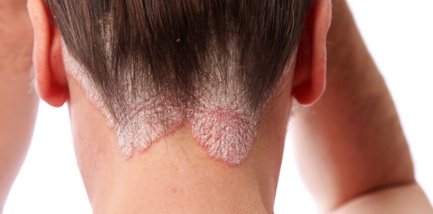 Psoriasis en el cuero cabelludo: causas y tratamientos naturales Psoriasis en el cuero cabelludo: causas y tratamientos naturales