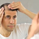 Cuáles son las primeras señales que indican que te vas a quedar calvo