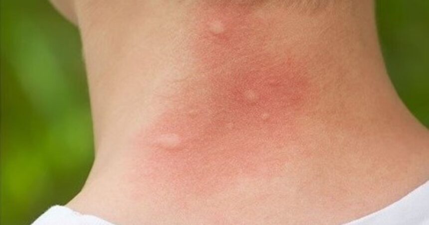 Cómo saber si la picadura es del mosquito del dengue o del que transmite encefalitis