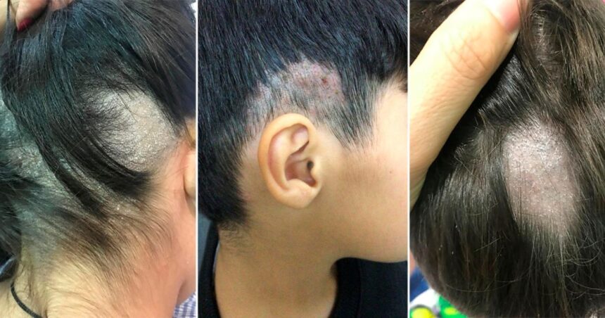 Advierten por la fuerte suba de contagios con un hongo que prolifera en peluquerías