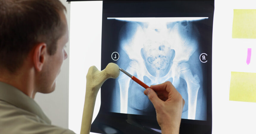 Cuántos años puede vivir una persona con síndrome de huesos de cristal u osteogénesis imperfecta Cuántos años puede vivir una persona con síndrome de huesos de cristal u osteogénesis imperfecta