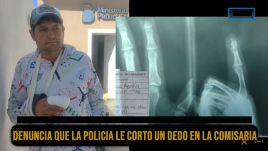 Denuncia que la policía le cortó un dedo en la comisaria Denuncia que la policía le cortó un dedo en la comisaria